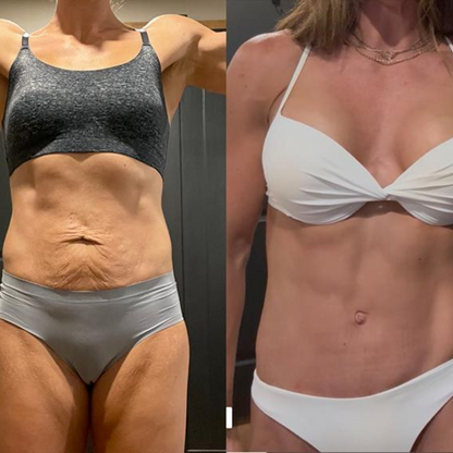 Lustra™ | Tighten Loose Skin & Flatten Your Tummy — Without Surgery