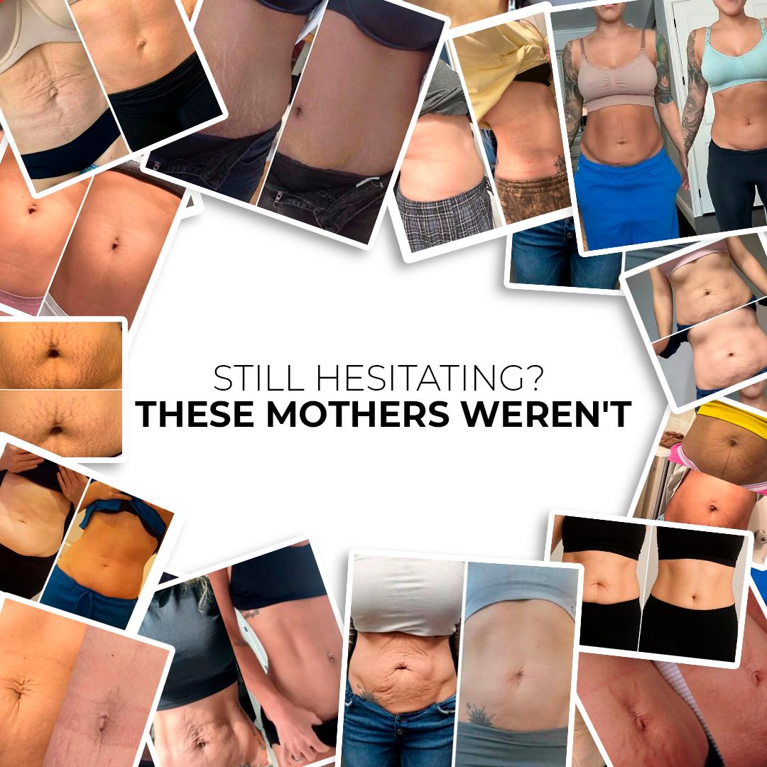 Lustra™ | Tighten Loose Skin & Flatten Your Tummy — Without Surgery